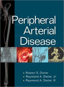 Picture of Peripheral Arterial Disease Part 2